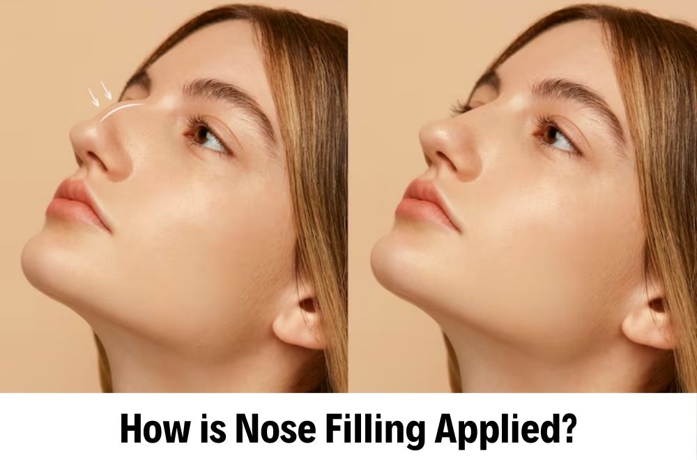 Nose Filler