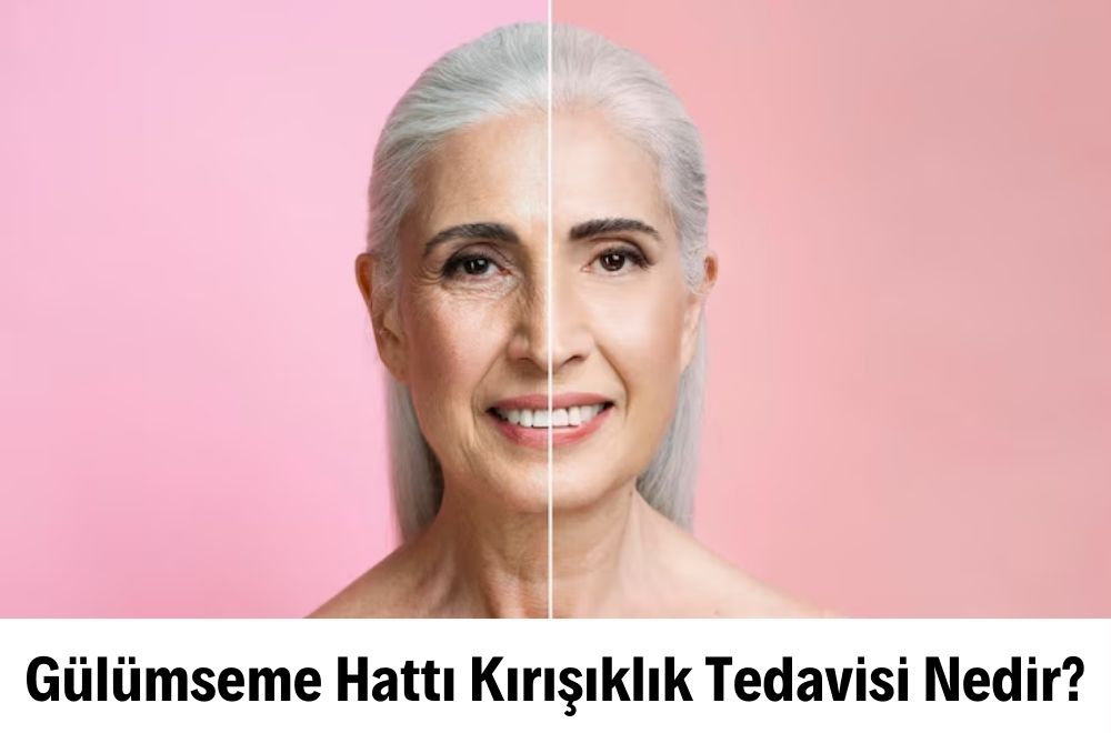 Gülümseme Hattı Kırışıklık Tedavisi