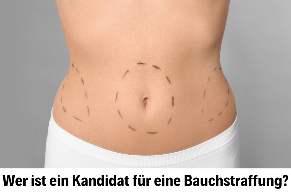 Bauchstraffung