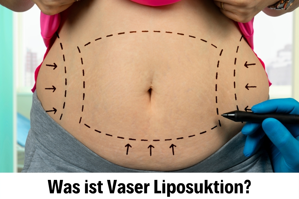 Vaser Liposuktion