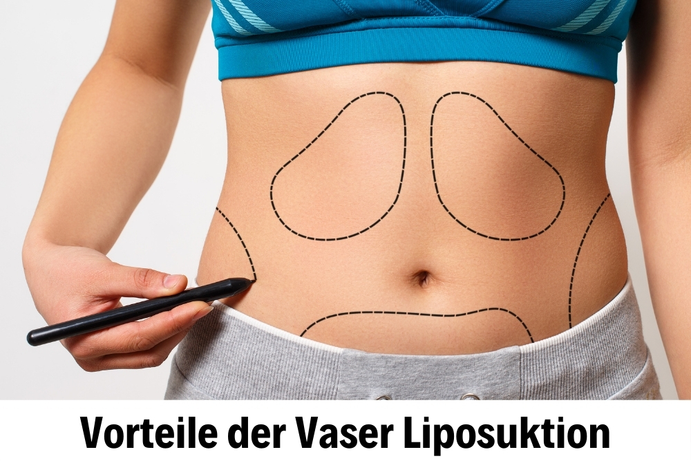 Vaser Liposuktion