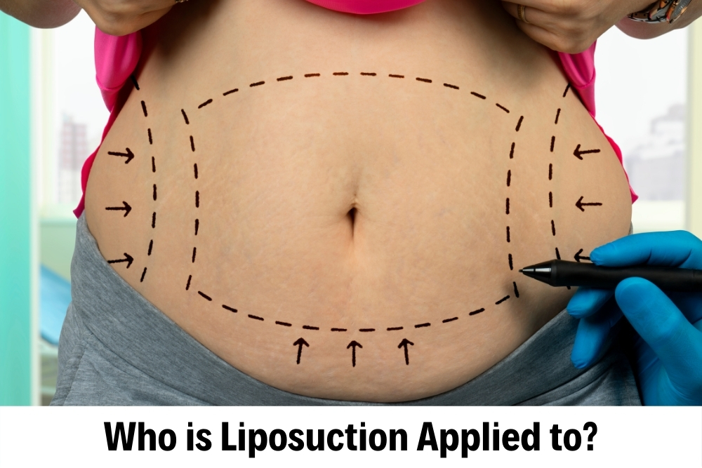 Liposuction