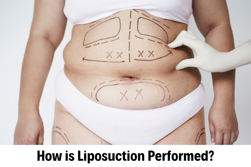 Liposuction