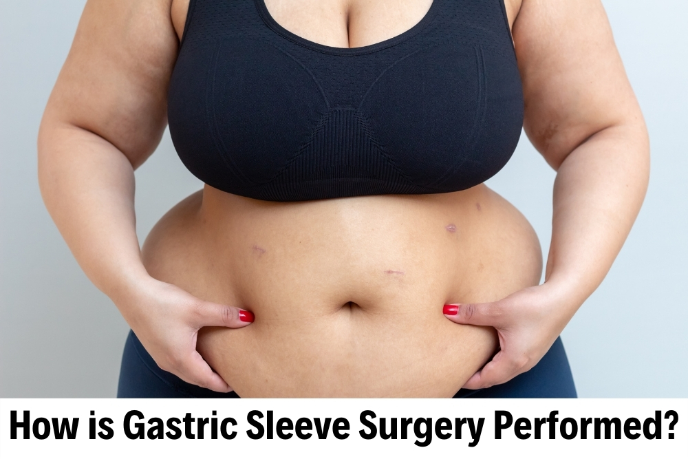 Gastric Sleeve Surgery