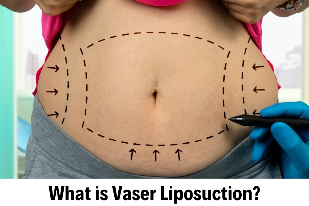 Vaser Liposuction