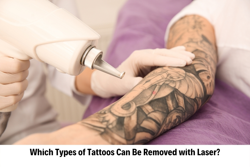 Laser Tattoo Removal