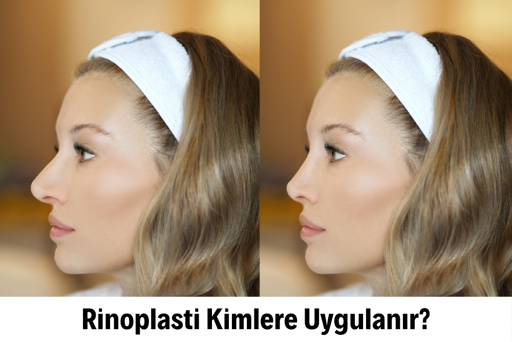 Rinoplasti 