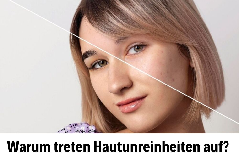 Behandlung von Hautunreinheiten