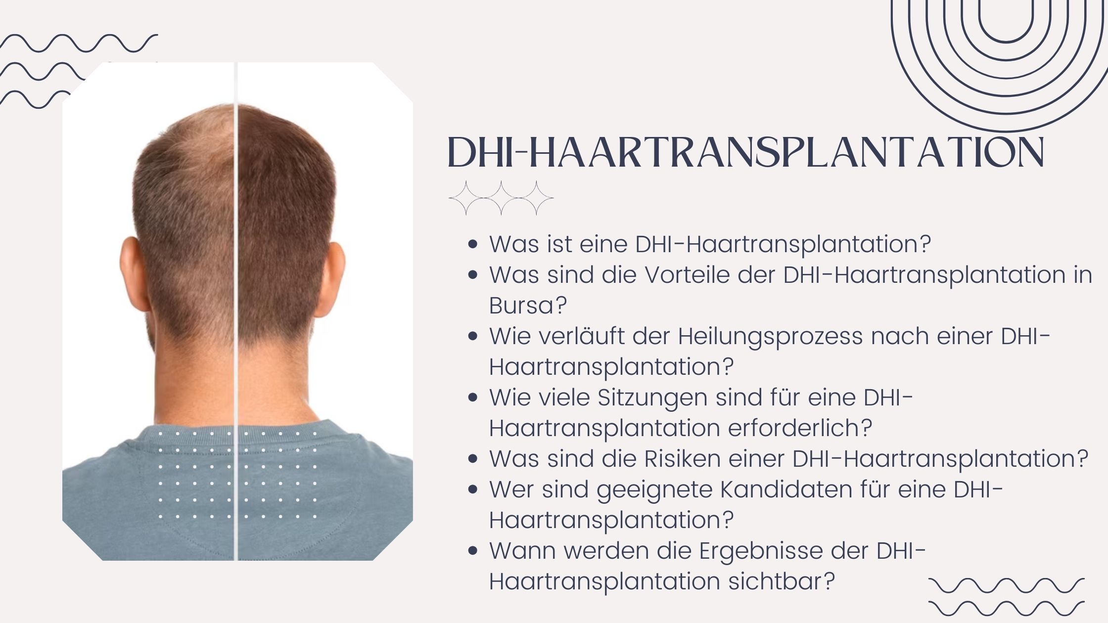 Haartransplantation