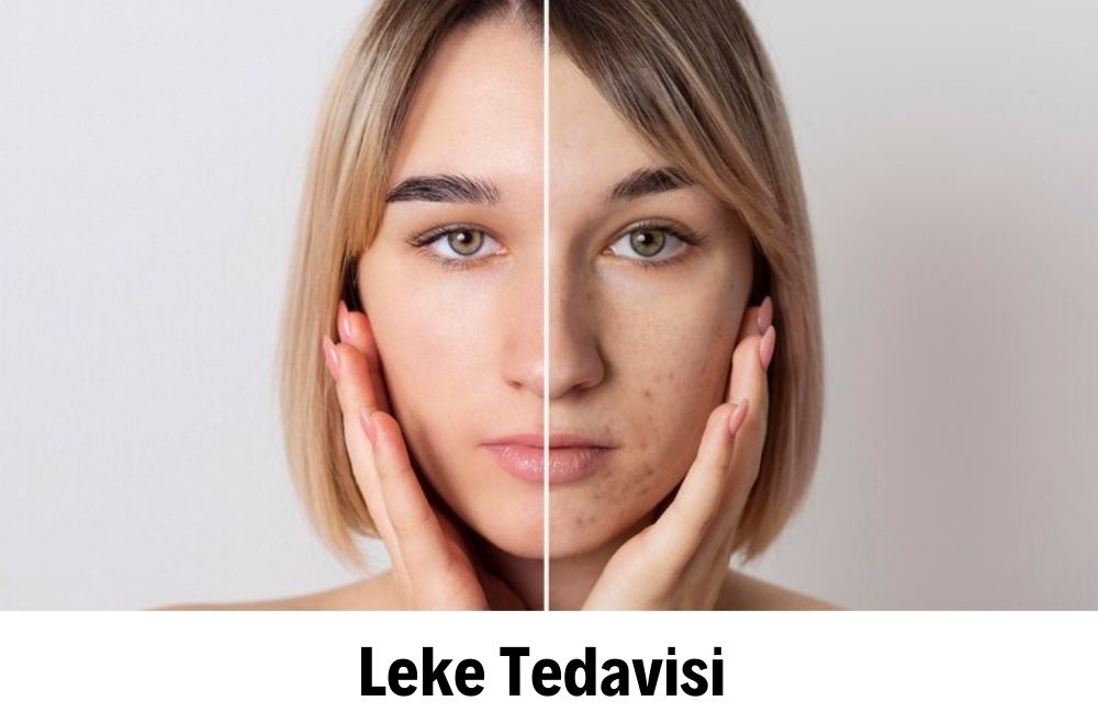 Leke Tedavisi