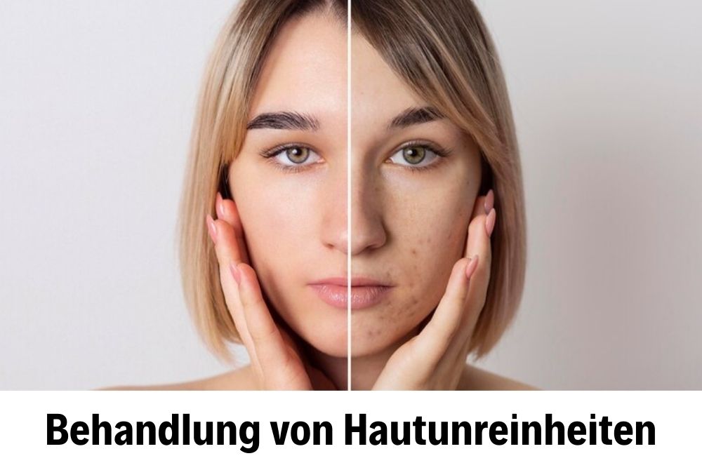 Behandlung von Hautunreinheiten