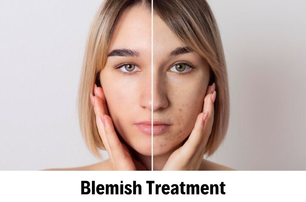 Blemish Treatment