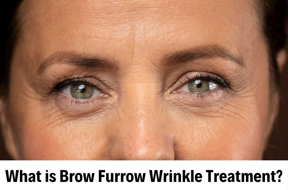 Brow Furrow Wrinkle - Unisahealth