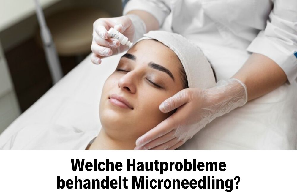 Microneedling 