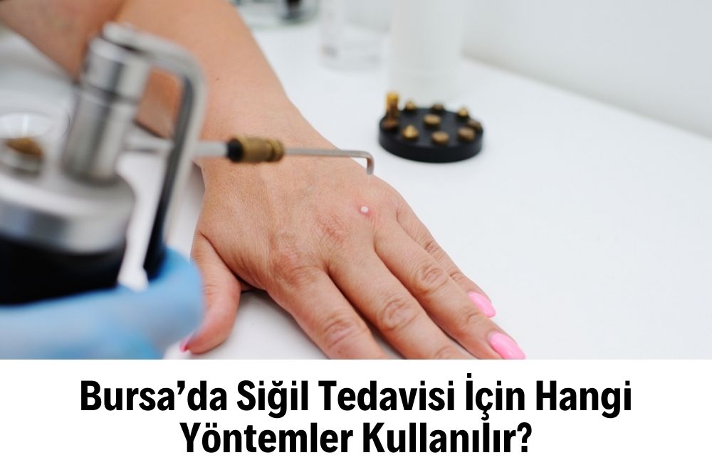 Siğil Tedavisi