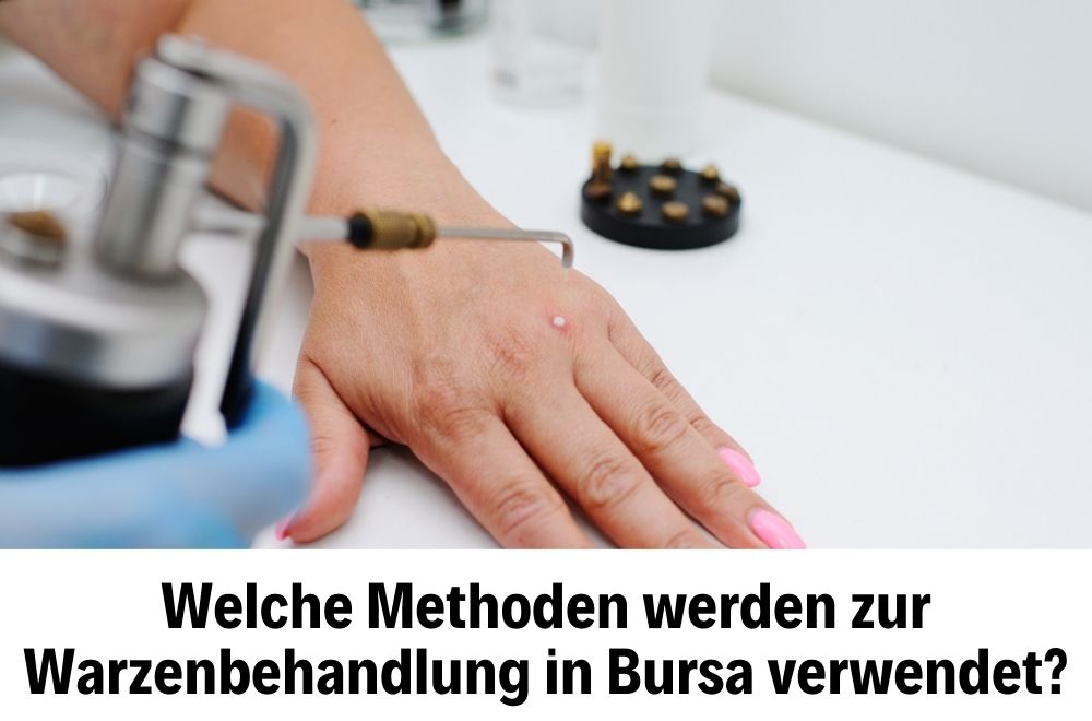 Warzenbehandlung