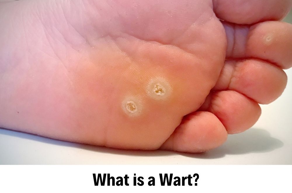 Wart Treatment