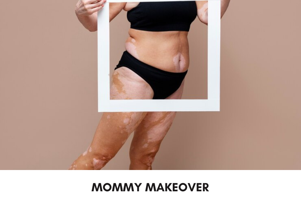  Mommy Makeover 