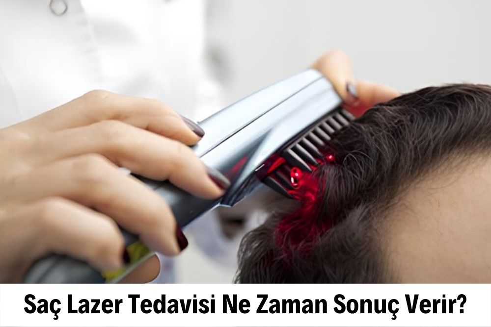 Saç Lazer Tedavisi